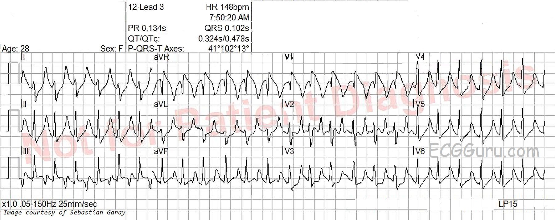 Tachycardia In An Unresponsive Patient Ecg Guru Instructor Resources